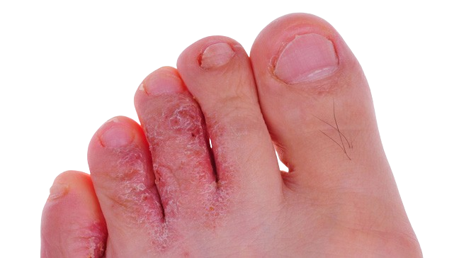 Athlete’s foot